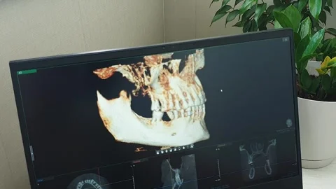 Rotating 3D Dental CBCT Scan showing Missing Tooth Gap in Lower Jaw. Dental Stock Footage 341286995