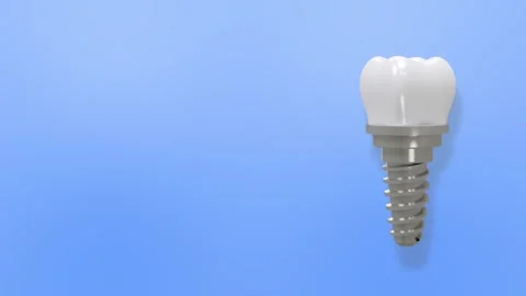 Rotating 3D Dental Implant Model on Blue Background with Copy Space Stock Footage 330367900