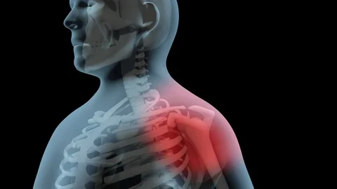 Rotator Cuff Surgery Stock Footage 121687075