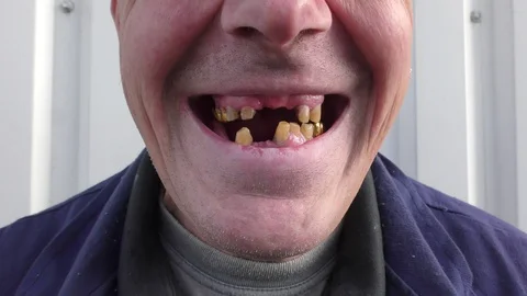 Rotten and fallen teeth of men. Without care, teeth may suffer. Video stock 118936839