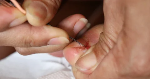 Rotten toenails, bleeding on the feet,Nail figure Stock Footage 139001553