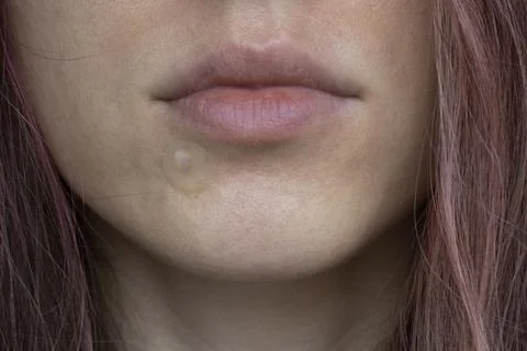 Round clear patch of acne on women's skin on the chin in close-up Stock Photos