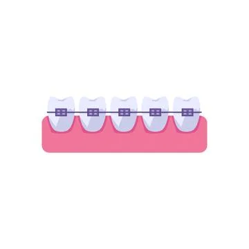 Row of teeth with metal braces flat style, vector illustration Stock Illustration