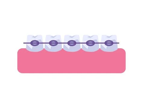 Row of teeth with metal braces flat style, vector illustration Stock Illustration