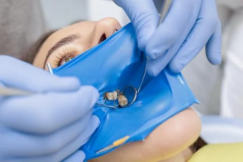 Rubber dam isolation on molars with mirror and explorer during dental treatme Stock Photos