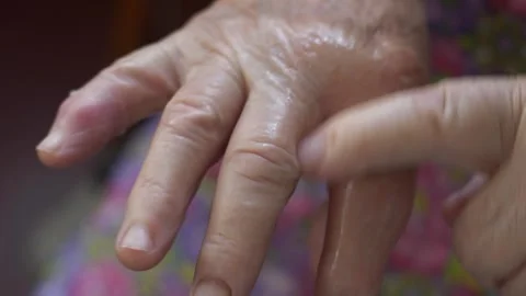 Rubbing ointment on an elderly womans hand to treat Lymphedema Stock Footage 281188742