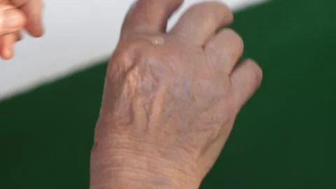 Rubbing ointment on an elderly womans hand to treat Lymphedema Stock Footage 281188769
