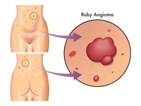Ruby angioma Stock Illustration