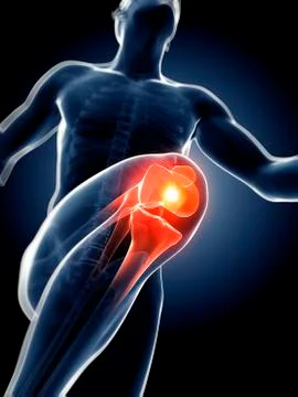 Runner's knee joint, artwork Stock Illustration