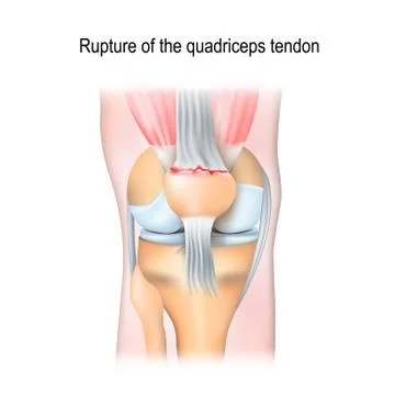 Rupture of the quadriceps tendon. Stock Illustration