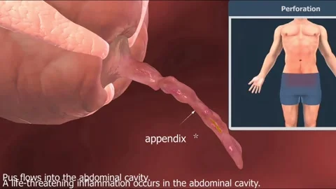 Ruptured appendix Stock Footage 269203492
