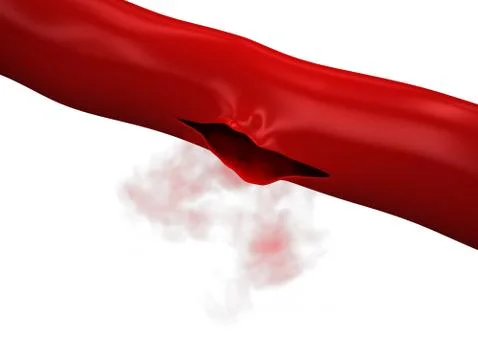 Ruptured Vein - Artery bleeding 스톡 일러스트