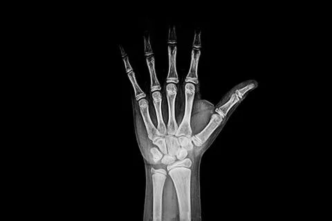 Rx image of left hand of adolescent for bone age. Stock Photos