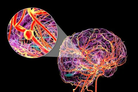 A saccular brain aneurysm, 3D illustration Stock Illustration