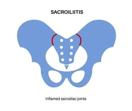 Sacroiliitis medical poster Illustrazione stock