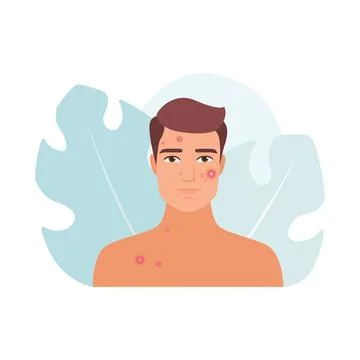 Sad worried man with acne problem and red pimples on face Illustrazione stock