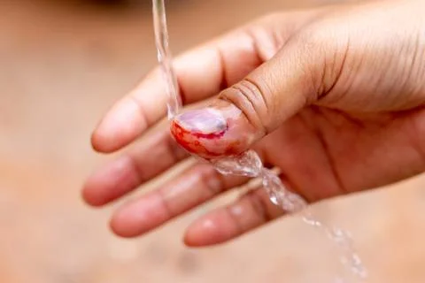 The saline solution is poured over the human finger with black nails, bruised Stock Photos