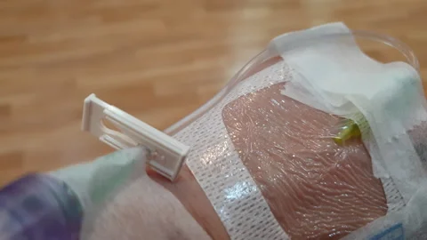 Saline solution tube and needle prepare on patient hand at hospital Stock Footage 249820241