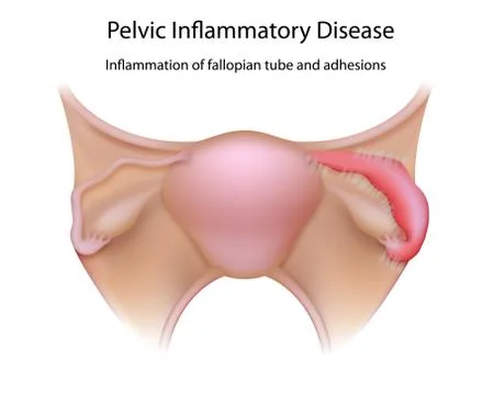 Salpingitis, inflammation of the fallopian tubes Stock Illustration