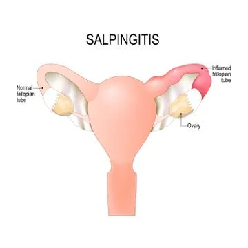 Salpingitis. inflammation in the Fallopian tubes. Stock Illustration