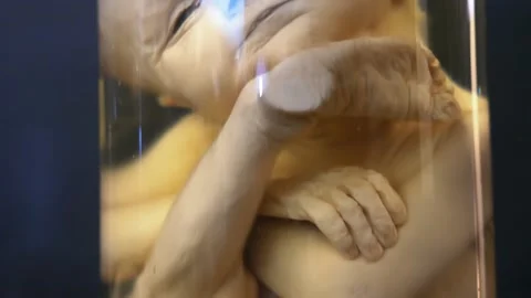 Sample of human fetus with anatomical abnormalities in jar of formaldehyde in Stock Footage 205098610