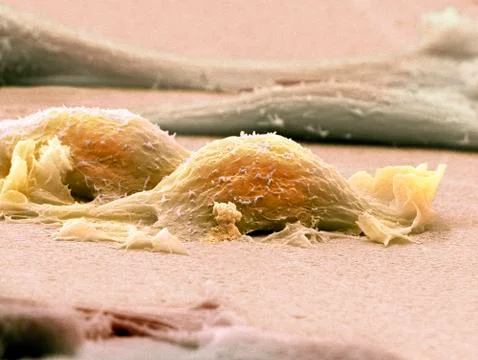 Sarcoma cells, sem Stock Photos