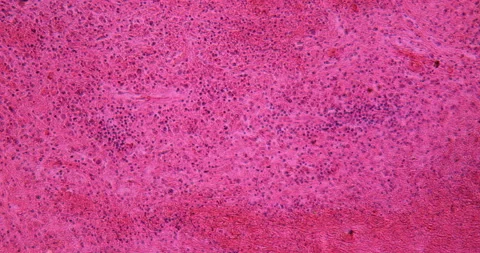 Sarcoma of the lymphatic gland diseased Stock Footage 145259964