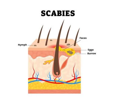 Scabies mite skin structure. Labeled nymph, feces, eggs, burrow. Contagious.. Stock Illustration