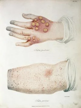 Scabies porcina; from Delineations of Cutaneous... 1817 Stock Photos