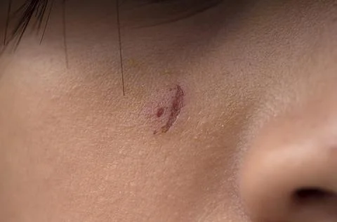 Scabs of small wounds on teenage girl's face Stock Photos