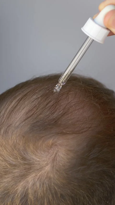Scalp Serum Application For Thinning Crown Closeup Dropper Dispensing Solution Stock Footage 327638462