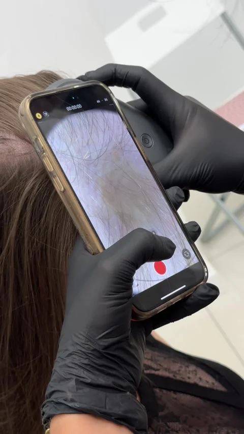 Scalp trichoscopy examination with digital dermatoscope close up, dermatologist Stock Footage 333707535