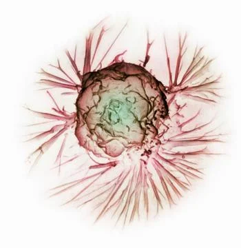 Scanning Electron micrograph, breast cancer cell Stock Illustration