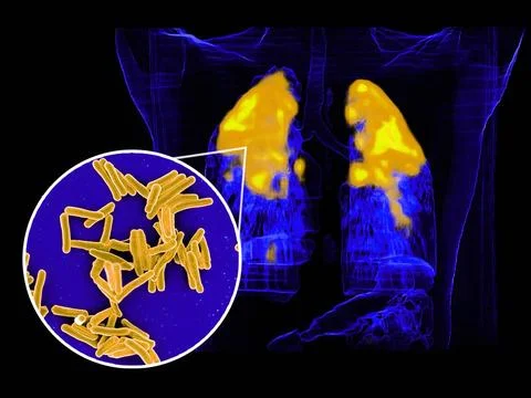  Scanning electron micrograph of Mycobacterium tuberculosis bacteria, whic... Stock Photos