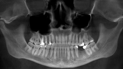 Scanning of the human skull and teeth, x-ray Stock Footage 125282580