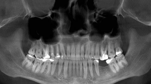 Scanning of the human skull and teeth, x-ray Stock Footage 169166301