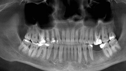 Scanning of the human skull and teeth, x-ray, panorama Stock Footage 169166889