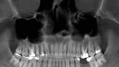 Scanning of the human skull and teeth, x-ray Stock Footage 169167515