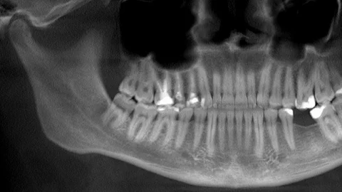 Scanning of human teeth, x-ray, panorama Stock Footage 125282896