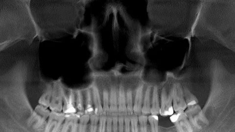 Scanning of human teeth, x-ray, panorama Stock Footage 125283110