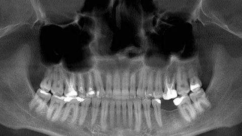 Scanning of the human teeth, x-ray Stock Footage 169166750