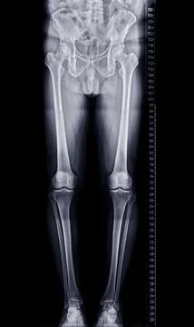 Scanogram is a Full-length standing AP radiograph of both lower extremities.. Stock Illustration