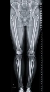 Scanogram is a Full-length standing AP radiograph of both lower extremities.. 스톡 일러스트