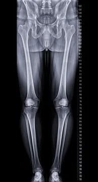 Scanogram is a Full-length standing AP radiograph of both lower extremities.. Stock Illustration