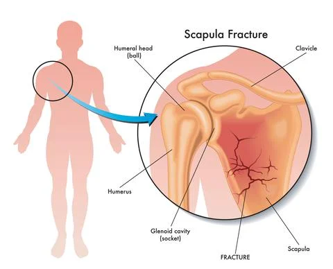 Scapula fracture Stock Illustration