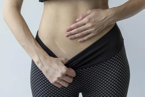 Scar from a healed appendix on a slender young woman. Stock Photos
