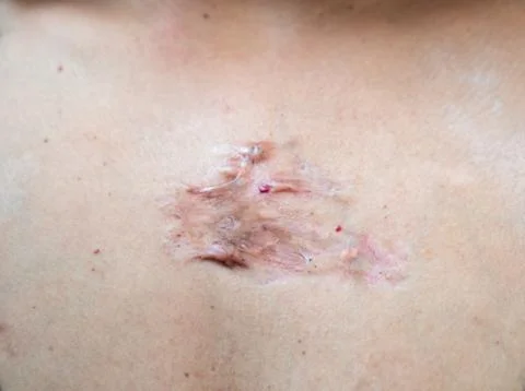 Scar Keloid and Hypertrophic  Occurring in the  women chest. Stock Photos