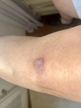 Scar in knee Stock Photos