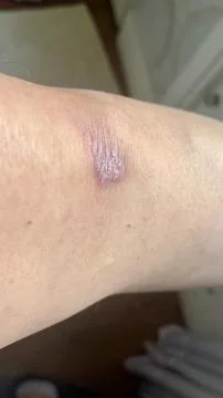 Scar in knee Stock Photos