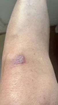 Scar on knee Stock Photos